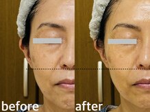 ほうれい線/小じわ/乾燥/小顔/ツヤ/フェイスライン引き上げ