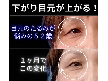 目元 口元のたるみ 眉間シワ改善専門サロン/目元たるみを何とか変えたい方用