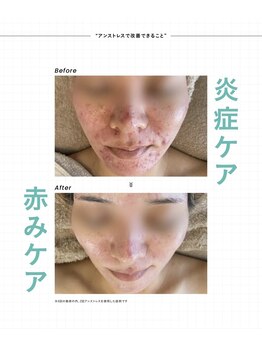 ミレラ(Mirela)/ダメージ肌を潤い満たされる肌へ