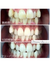 ホワイトニングサロン 京都烏丸店/ホワイトニング施術例