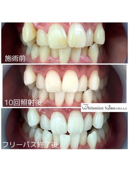 ホワイトニングサロン 京都烏丸店/ホワイトニング施術例