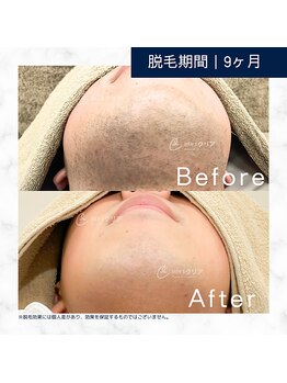メンズクリア 武蔵小杉店/【メンズクリア】お客様の施術例