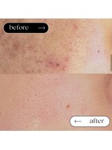 トータルビューティーサロンリア(Li'a)/ビフォー＆アフター