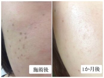 ヌー 栄(nuu)/シミケア1か月後