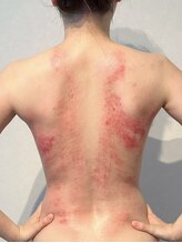 ビレイ(Birei)/カッサ