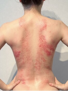 ビレイ(Birei)/カッサ