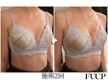 フーアップ 北千住(FU-UP)/バストアップ/育乳（2回）