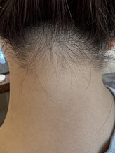 プルメリア 高崎(Plumeria)/うなじ脱毛