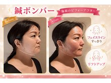 ラ コンシェル たまプラーザ店/大人気鍼ボンバー！