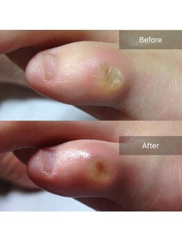 サロン ド ピュアボディ(salon de PureBody)/フットケア～症例