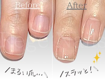 自爪育成・深爪改善コース