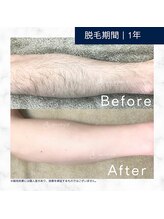 メンズクリア 武蔵小杉店/【メンズクリア】お客様の施術例