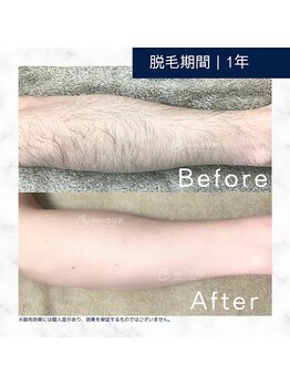 メンズクリア 武蔵小杉店/【メンズクリア】お客様の施術例