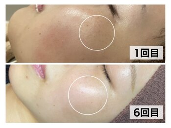 モテ美白/小顔マッサージ付でリラックス