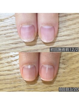自爪育成ネイルケア
