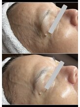 ティアーナ(Tiaana)/ララピール5回アフター