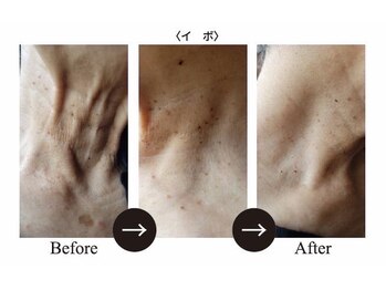 サロンドベル(salon de Belle)/プラズマ/毛穴/透明感/くすみ