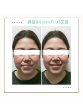 ビーフル バイ ブリリアントヘアー(beafull by brilliant hair)/フェイシャルエステbeforeafter