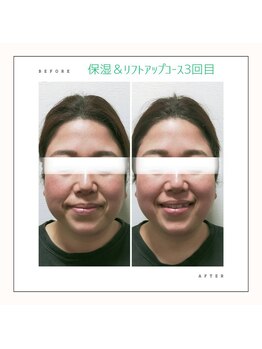 ビーフル バイ ブリリアントヘアー(beafull by brilliant hair)/フェイシャルエステbeforeafter