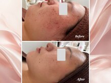 ファシル(Facile)の雰囲気（敏感肌でも大丈夫！ハーブピーリング）