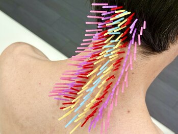 とだ鍼灸院の写真/【歴14年】≪理学療法士☆鍼灸師☆柔道整復師≫『深刻な頭痛/首肩こり★腰痛/尻★股膝』広範囲トリガー鍼◎