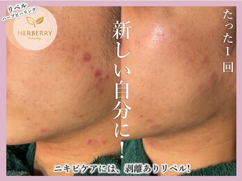 ハーバリー ハーブピーリング 大阪梅田店(HERBERRYハーブピーリング)/梅田ハーブピーリングHERBERRY