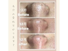 リンカ(Rinca)/毛穴エクストラクション/脱毛