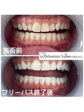 ホワイトニングサロン 京都烏丸店/ホワイトニング施術例