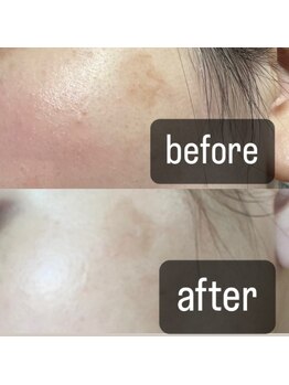 エステルーム アンジュ(Esthe Room Ange)/最大70%OFF 初回シミケア