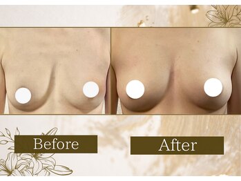 マリン(MARINE)/下垂改善Before→After