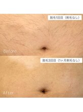 エフイーサンニーイチ(Fe-321)/お腹脱毛　ビフォーアフター