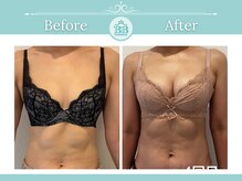 美人バスト 浜松店/◇ バストアップ &nbsp;BeforeAfter◇