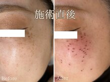 シエナ(ciena)/シミケア　施術直後