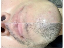 カルム(Calme)/ヒゲ脱毛　３０代