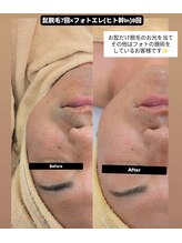 クレール 小山店(CLAIR)/【美肌フォト×ひげ脱毛】