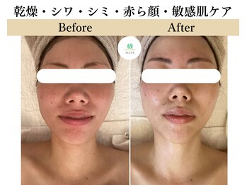 ミューズ 成城(MUSE)の写真/【毛穴・小顔・シミ・乾燥・カサつき・くすみ・色ムラ】小じわを改善フェイシャルエステ+ヘッド付き