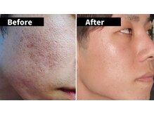 リコリス(Lycoris)/フォ○フェイシャルフェイシャル