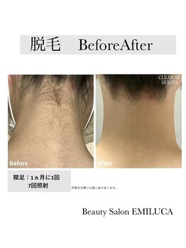 エミルカ(EMILUCA)/うなじ脱毛