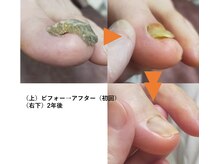 タッタ ソールの雰囲気（段差のある盛り上がった 【重複爪ケア】 ご相談ください☆）