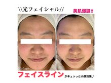 ココネイル 板山店(coco nail)/人気No.1連射式＊光フェイシャル