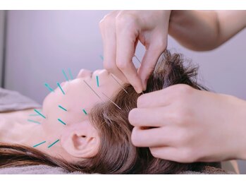 ヴェリタス(VERITAS)/美容鍼の一例です。