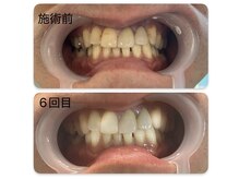 ホワイトニング専門店　スマイルホワイト/40代男性