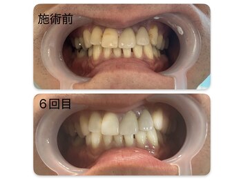 ホワイトニング専門店 スマイルホワイト/40代男性