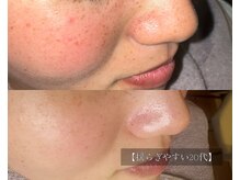 ル シーニュ/赤み・くすみ・目立つ毛穴20代