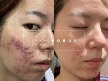 ボウ 名古屋店(VOEUX)の写真/20代・30代・40代の大人ニキビ専門◎
専門歴13年・23,000人の実績・完全個室サロン