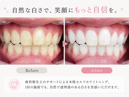 ココホワイトニング(coco whitening)の写真