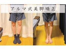 美容整体 アルマ/O脚3ヶ月改善コース