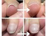 【巻き爪でお悩みの方】巻き爪ケアコース