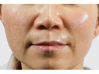 ルボアスパ 住道店(LE BOIS SPA)/住道　肌質改善BEFOR AFTER