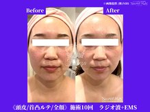 フェレザ 新潟(Felleza)/エレクトロポレーション